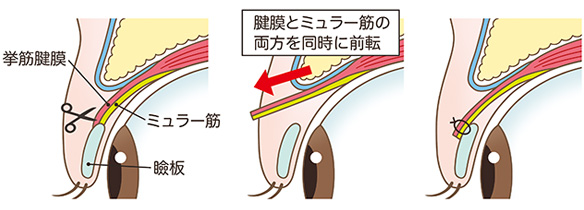 挙筋短縮術
