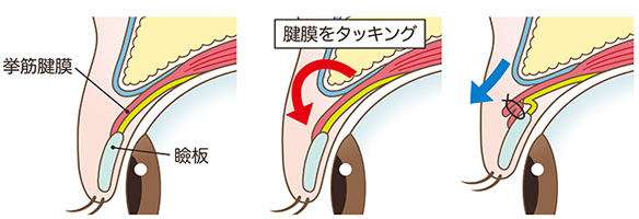 挙筋腱膜タッキングの施術方法