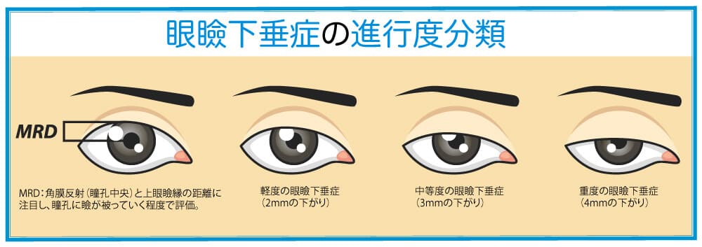 眼瞼下垂症の進行度